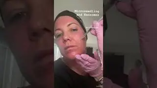 Microneedling with Exosome and LED Light therapy 