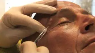 Liquid Face Lift