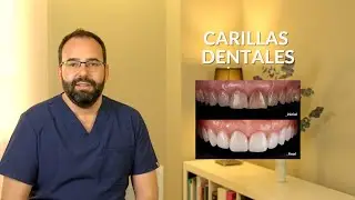 CARILLAS DE PORCELANA O DE COMPOSITE: ¿Cuáles elegir?
