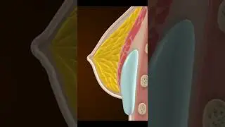 Breast Augmentation Surgery: Enhancing Confidence