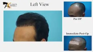 2000 Grafts FUE Hair Transplant Result after 8 Month by Dr Kapil Dua, India