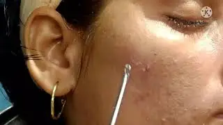 Pimple के अंदर से कील कैसे निकाले
