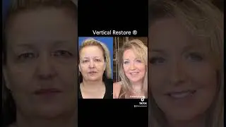 JAW-DROPPING Facelift Transformation!