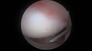 L Rotator Cuff Repair 11 6 23 MF