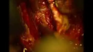 Cervical Spine Surgery:  ACDF C5C7 anterior cervical discectomy and fusion
