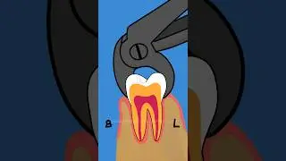 Extraction of Broken Root Piece  
