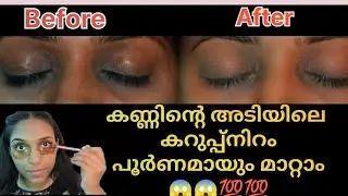 Dark circle ഉണ്ടാകാൻ കാരണമെന്ത് 😱😱||വെറും 7 ദിവസം കൊണ്ട് dark circle മാറ്റാം!!!