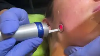 PicoWay Resolve Laser Facial in action