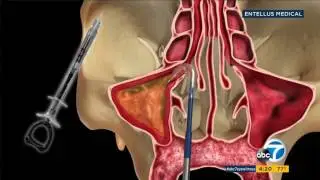 Dr. Farhad Sigari on KABC-TV Channel 7 news Los Angeles