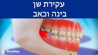 ©  עקירת שן בינה וכאב