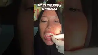 PROSES PEMASANGAN RETAINER GIGI