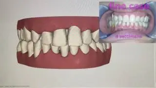 rapid invisalign