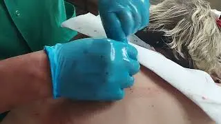 Удаление большого  доброкачественного новообразования. Липома спины.