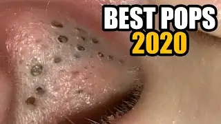 Mr. Blackheads Best Ear Blackheads & Dilated Pores of Winer, Spring 2020