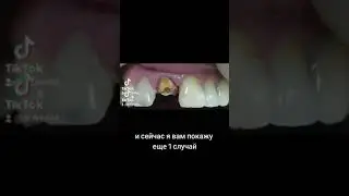 Спасение переднего зуба!