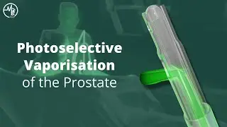 Photoselective Vaporisation of the Prostate | Benign Prostatic Hyperplasia (BPH)