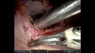 Uniportal Robotic Diaphragmatic Hernia Repair