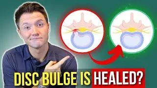 What I tell My Patients When They Ask If Their Disc Bulge is Fully Healed
