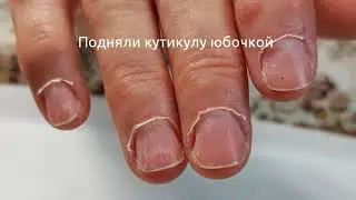 Поднятие кутикулы 