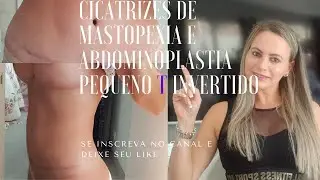 MINHAS CICATRIZES E PEQUENO T DA ABDOMINOPLASTIA E CICATRIZES DA MASTOPEXIA/ SILICONE APÓS 7 MESES!