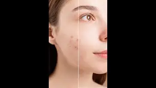 Photoshop Tutorial: How to remove pimples with Photoshop