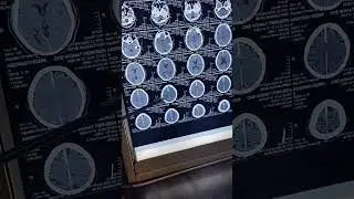 interhemisphetic subdural hematoma 