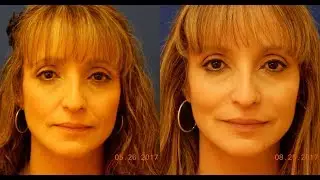 Expert Dermal Filler Injection - Nasolabial Folds NLF - Juvederm Vollure XC