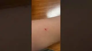 umm just a lil bleeding