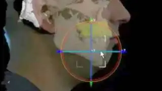 3-D Virtual Jaw Surgery Demonstration