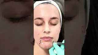 Instant Glow-Up: Educational Dermal Filler Transformation | Doctor's Precision