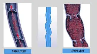 About Itchy Varicose Veins with Dr. Jose Almeida