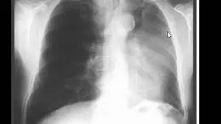 Chest x-ray - Luftsichel Sign - Left upper lobe collapse