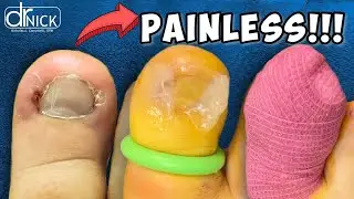 How to Fix an Ingrown Toenail!