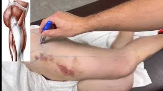 Как навсегда избавиться от боли в ноге?! Просто повторяйте! Deep tissue massage. Миопрессура