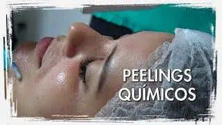 Peelings Químicos