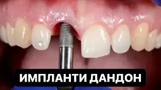 Импланти дандонҳо