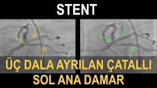 STENT | Üç Dala Ayrılan Çatallı Damar (LMCA Trifurkasyon Vakası)
