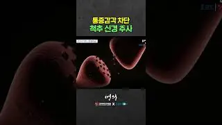 초기 허리통증에 시도하는 척추 주사