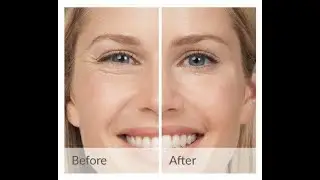 Rejuvenecimiento Facial con Plasma Pen  Aspecto Juvenil sin Cirugía