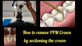 How to remove PFM Crown by Sectioning the Crown