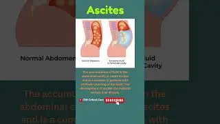 Ascites|Fluid Buildup in Peritoneal Cavity|Abdomen Disease| Ascites due to Liver Disease 