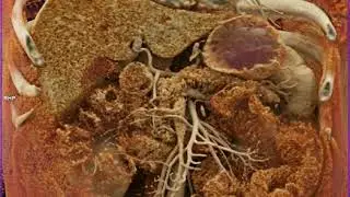 Pancreatic Cancer with Preop Staging with Cinematic Rendering