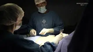 LIPO HD/LAD E MASTOPEXIA COM PRÓTESES