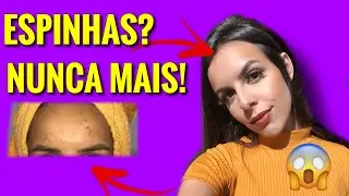 ACABEI COM MINHAS ESPINHAS EM 5 DIAS! 😱😍