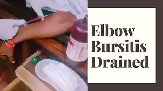 What is Bursitis? How to drained #Vlog 07👨‍⚕️