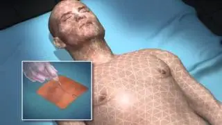 Aspect Medical BIS