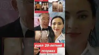 Псориаз