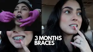 3 MONTHS BRACES UPDATE (I REGRET THIS...)