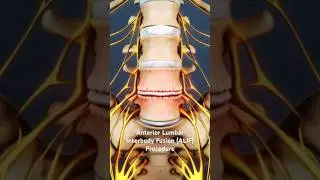 Anterior Lumbar Interbody Fusion (ALIF) Procedure