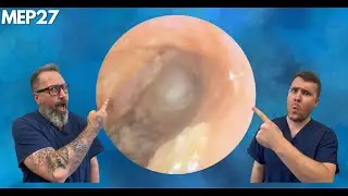 FUNGAL EAR INFECTION REMOVAL - MEP27